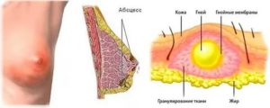 Что такое абсцессы в грудных железах