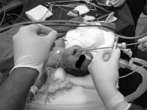 Как делают бронхоскопию новорожденным