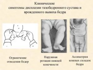 Как проверить тазобедренный сустав у новорожденного