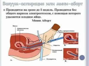 Когда можно заниматься интимной жизнью после медикаментозного выкидыша