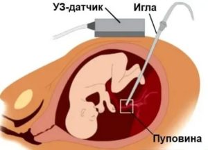 Как делается забор крови из пуповины