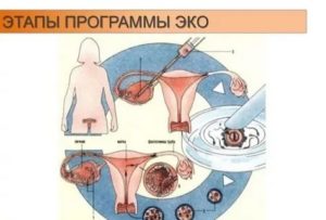 Как происходит искусственное зачатие