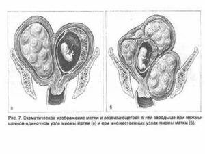 Можно ли беременеть при миоме матки малых размеров