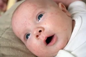 Что такое везикулезная сыпь у новорожденного