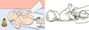 Как сделать новорожденному клизму с бактериофагом