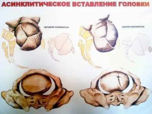 Что такое асинклитическое вставление головки плода