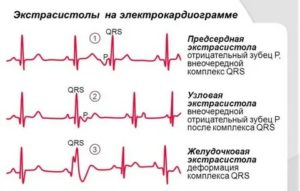 Что такое экстрасистолы у новорожденных