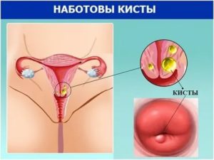 Можно ли беременеть если есть киста на шейке матки