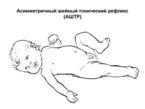 Что такое тонический шейный рефлекс новорожденного