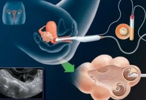 Как происходит перенос эмбрионов при эко на полный мочевой пузырь или нет