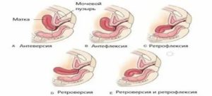 Если матка далеко расположена какие позы лучше всего для зачатия