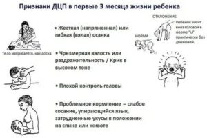 Когда диагностируется дцп у новорожденных детей