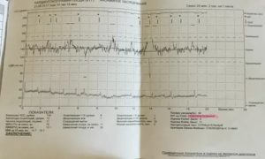 Что означает ктг плода подозрительная