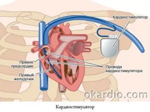 Можно ли беременеть с кардиостимулятором