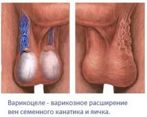 Можно ли вылечить бесплодие если вылечить варикоцеле