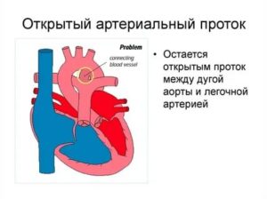 Что такое открытый артериальный проток у новорожденного