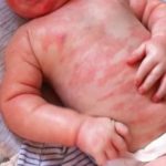 Как влияет дисбактериоз влагалища при зачатии