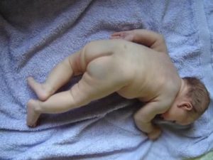 Почему у новорожденного синий копчик