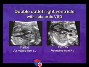 Что такое дисплазия трикуспидального клапана у плода