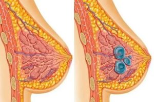Можно ли беременеть с мастопатией и кистами в молочных железах