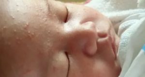 Что за сыпь у новорожденного с гнойничками маленькими