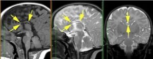 Что такое прозрачная перегородка в головном мозге у плода