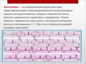 Что такое бигеминия плода