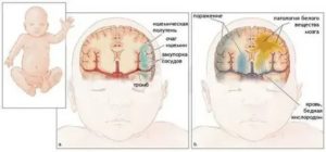 Может быть инсульт у новорожденного причины инсульта у новорожденных