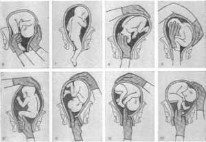 Почему ребенок не переворачивается вниз головой перед родами