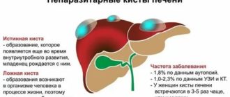 Эко и киста печени