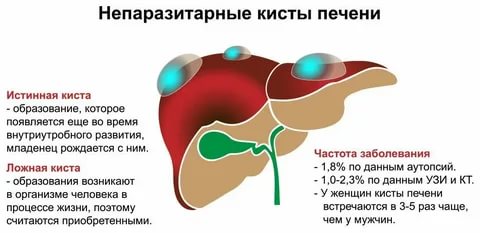 Эко и киста печени