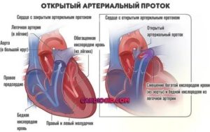 Что такое открытый артериальный проток у новорожденного