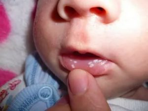 Что делать если у грудного ребенка белый налет во рту