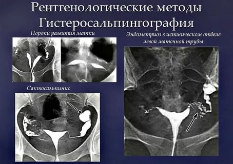 Через сколько дней после гсг можно планировать беременность после