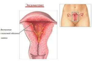Можно ли беременеть при метроэндометрите