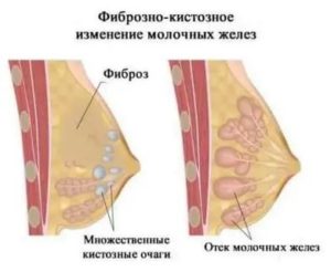 Почему набухли грудные железы что это такое