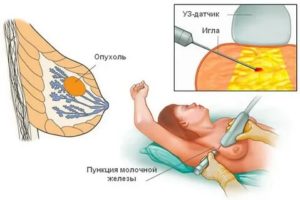 Что такое биопсия грудной железы у женщин