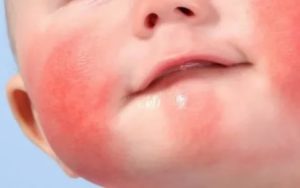 Как избавиться от диатеза у грудного ребенка на щеках