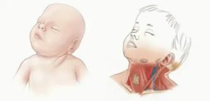 Можно ли повредить шею новорожденному ребенку