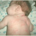 Можно ли бромгексин грудным детям