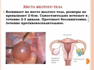 Можно ли беременеть при кисте яичника желтого тела