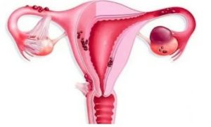 Можно ли беременеть при параовариальной кисте
