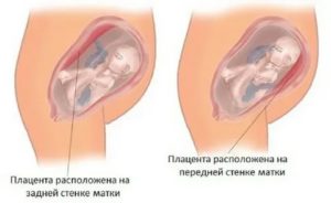 Что значит если плод на правой стороне