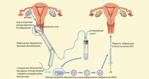 Что происходит с яичниками после пункции эко