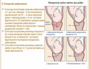 Что делать если схватки начались а шейка матки не открывается