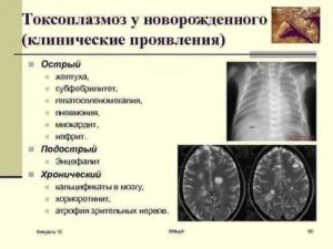 Как проявляется токсоплазмоз у новорожденных