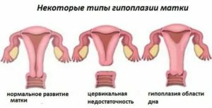 Можно ли родить с гипоплазией матки 1 степени