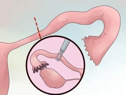 Когда можно делать эко после удаления маточных труб отзывы