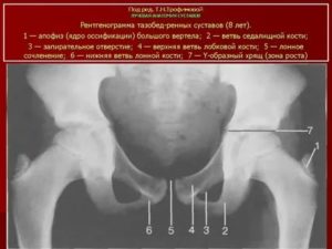 Что такое окостенение тазобедренных суставов у грудничков