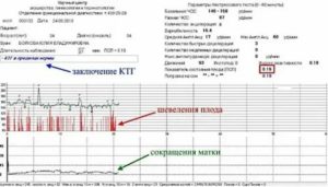 Как подготовиться к ктг плода утром